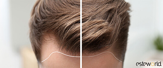 Esteworld Unshaven Hair Transplant Video Preview